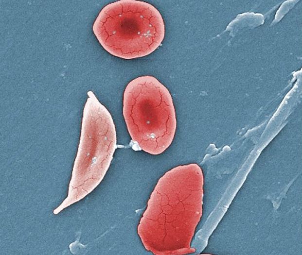 Siclemie (anemia cu celule în seceră) - Viata cu de toate | Facebook