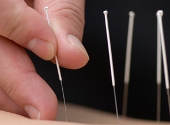 Acupunctura