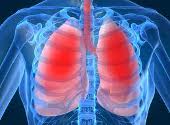 Infectie pulmonara