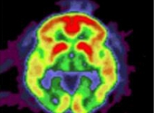 Imagine creier PET