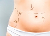 Liposuctie. Operatii estetice