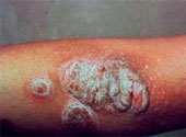 Psoriazis
