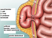 Hernie