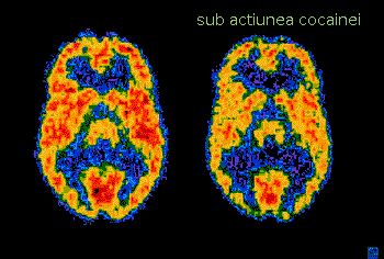 Creierul sub actiunea cocainei Creierul sub actiunea cocainei
