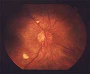 Retinopatie diabetica