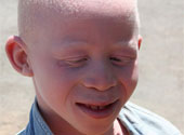 Albinism